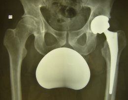 Total Hip Replacement Surgery